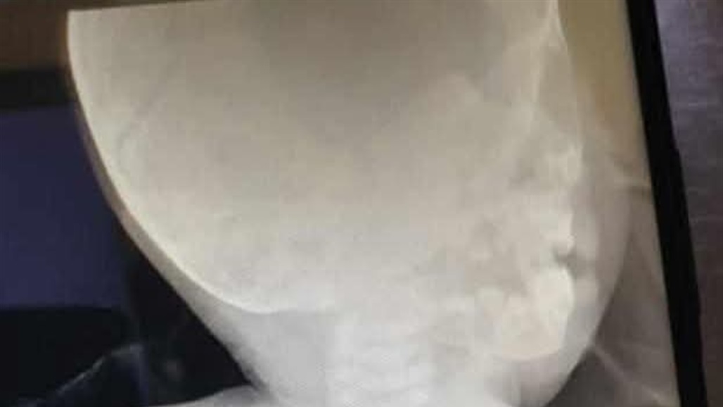 نينوى.. انقاذ طفل ابتلع حبة زيتون